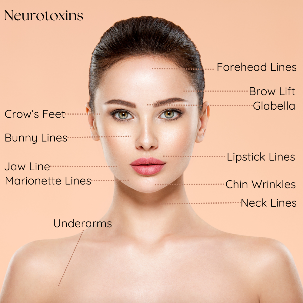 Facial diagram showing 10 common Botox injection zones including tear troughs, marionette lines, and crow's feet.