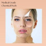 Model face highlighting key areas for facial chemical peel exfoliation and rejuvenation.