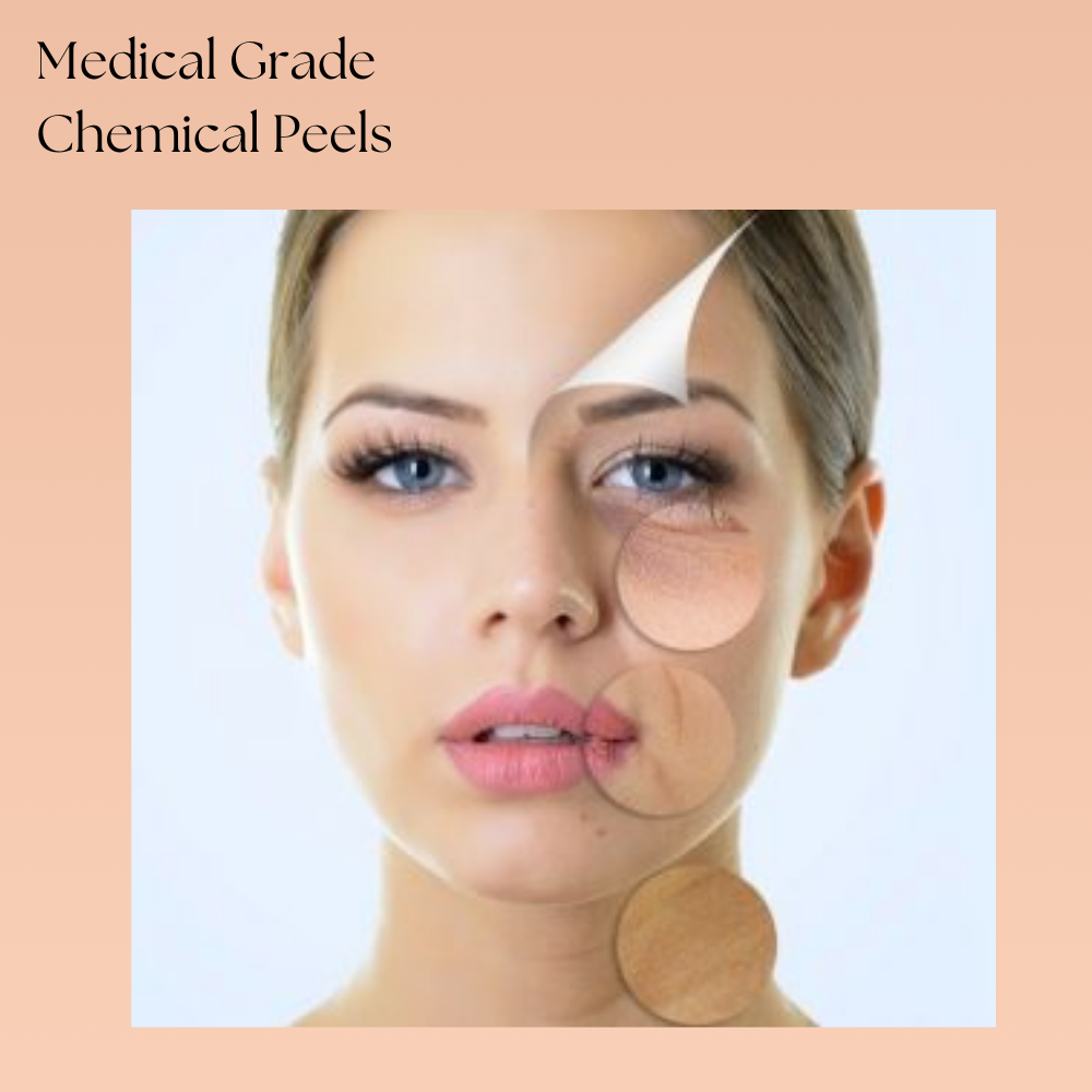 Model face highlighting key areas for facial chemical peel exfoliation and rejuvenation.