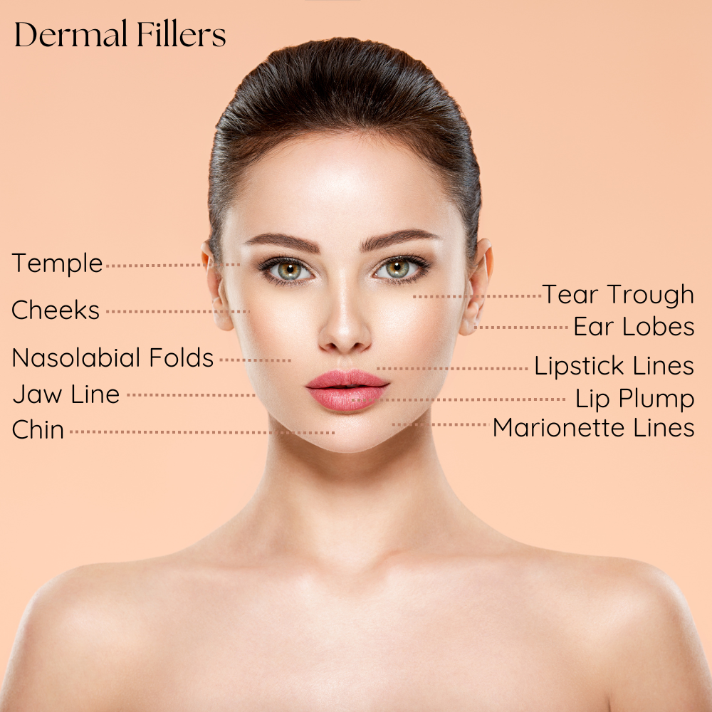 Diagram showing common dermal filler injection areas on a model's face, including cheeks, lips, tear troughs, and jawline.