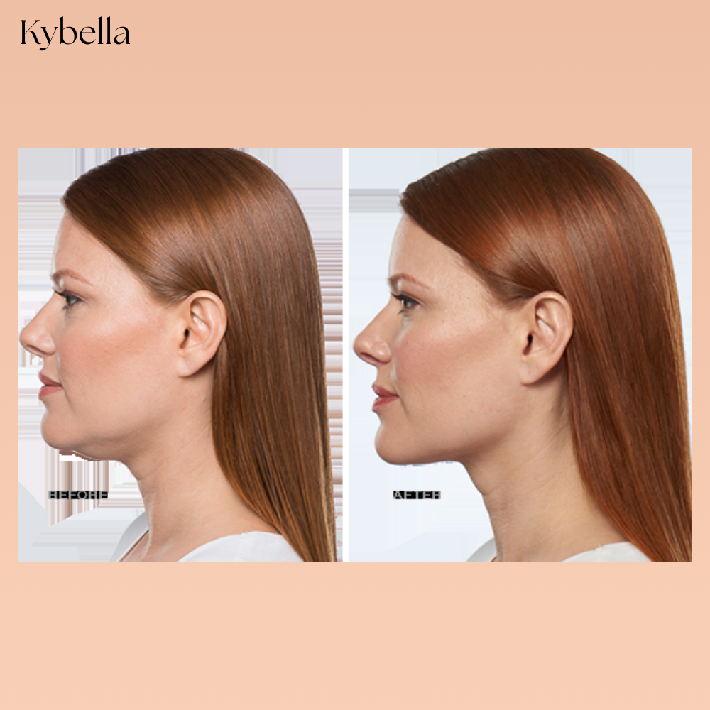 Profile diagram of submental fullness treatment zones for Kybella double chin injections.