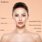 Facial diagram highlighting Radiesse injection areas like the jawline, chin, and nasolabial folds.