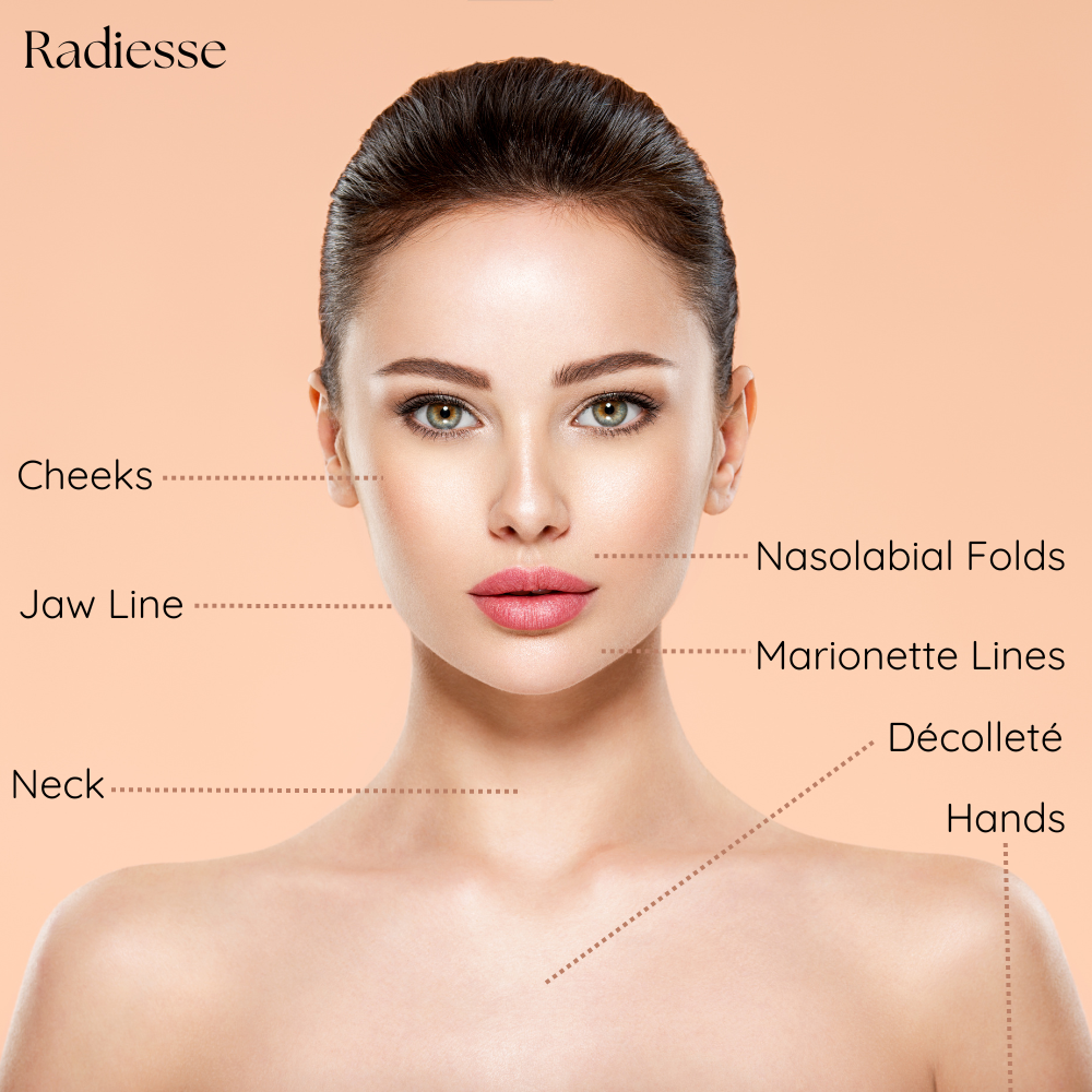 Facial diagram highlighting Radiesse injection areas like the jawline, chin, and nasolabial folds.