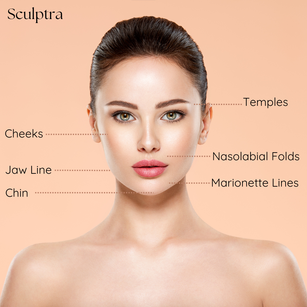 Facial diagram highlighting Sculptra collagen-stimulating treatment areas like cheeks and temples.