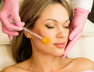 Model face highlighting key areas for facial chemical peel exfoliation and rejuvenation.